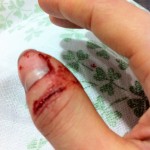 broken thumb